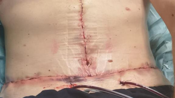 East Anglian Daily Times: The scars from Mr Edwards surgery are still healing following his stomach surgery Picture: HARLEY STREET SKIN CLINIC/ EMMA CATTELL East Anglian Daily Times: The scars from Mr Edwards surgery are still healing following his stomach surgery Picture: HARLEY STREET SKIN CLINIC/ EMMA CATTELL