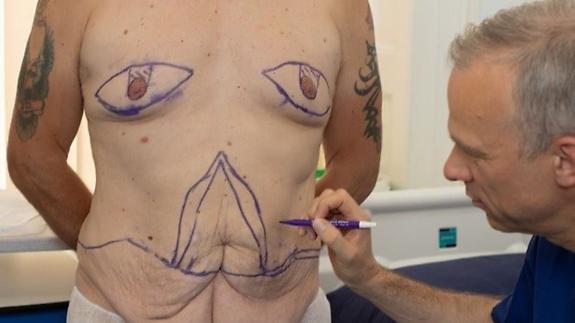 East Anglian Daily Times: The lines drawn by Dr Schumacher show where the skin had to be removed to leave Mr Edwards with a flat stomach Picture: HARLEY STREET SKIN CLINIC/ EMMA CATTELL East Anglian Daily Times: The lines drawn by Dr Schumacher show where the skin had to be removed to leave Mr Edwards with a flat stomach Picture: HARLEY STREET SKIN CLINIC/ EMMA CATTELL